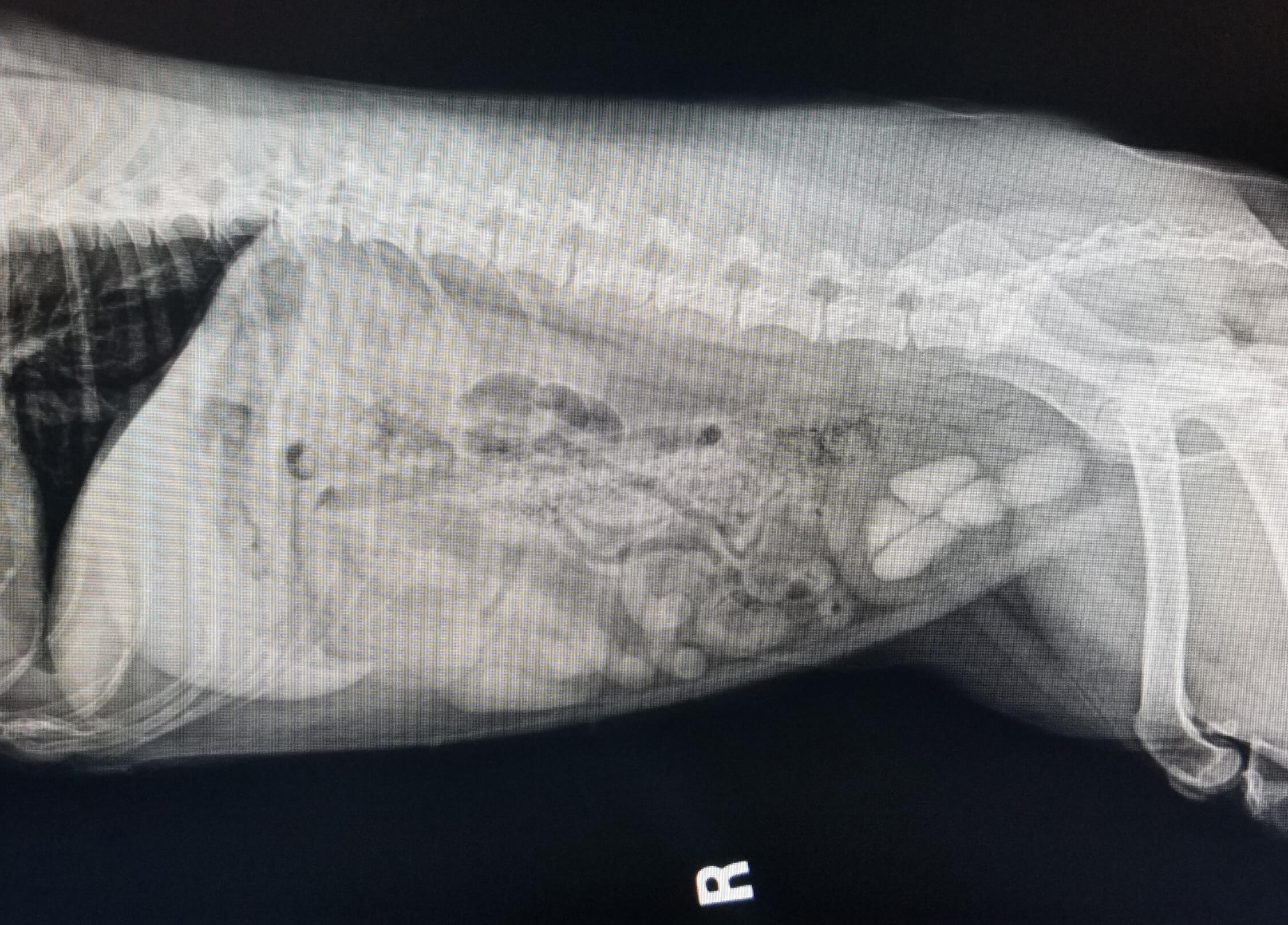 bladder stones before surgery